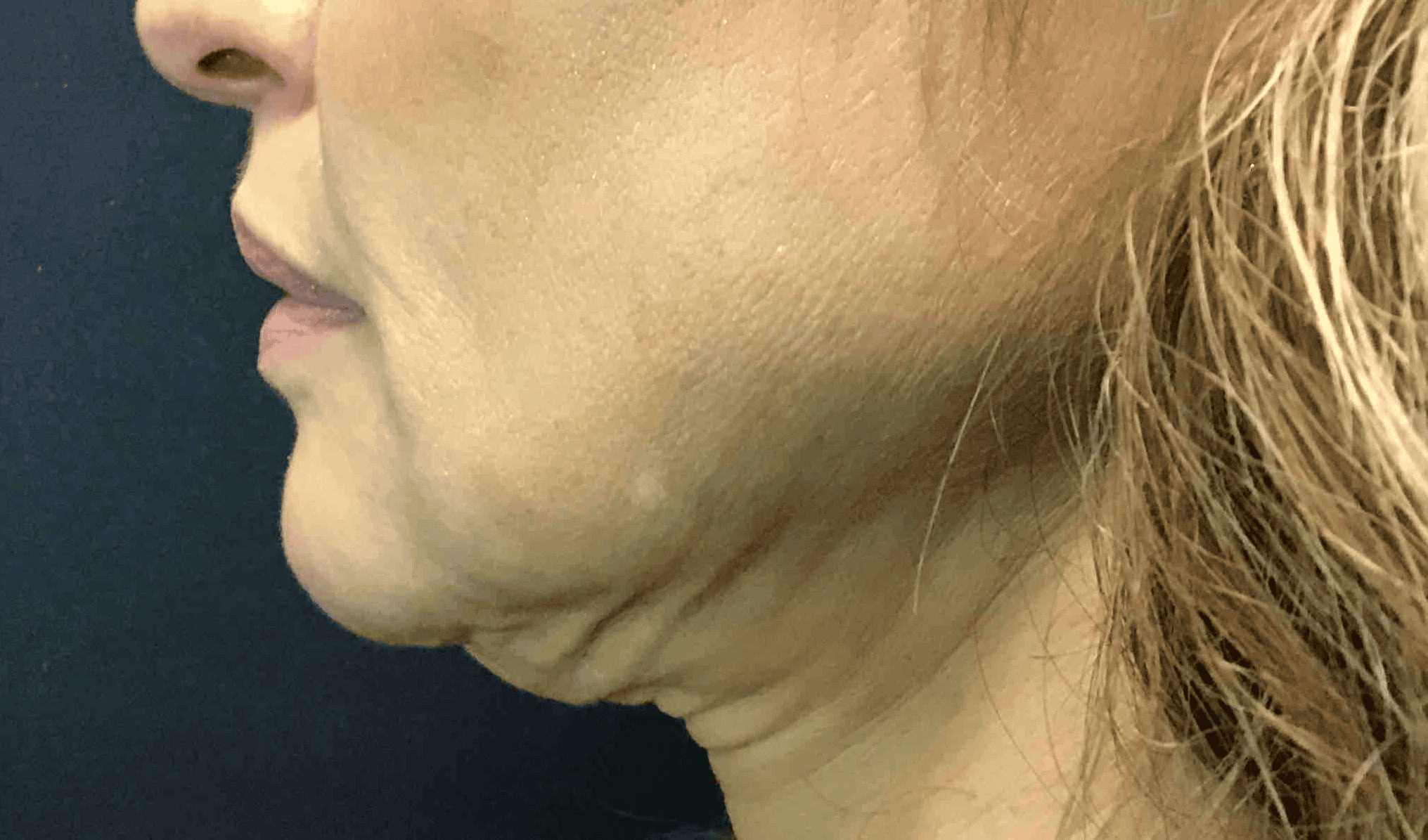 SOLTA_THERMAGE_HCP_BROCHURE_2025_05_12-34