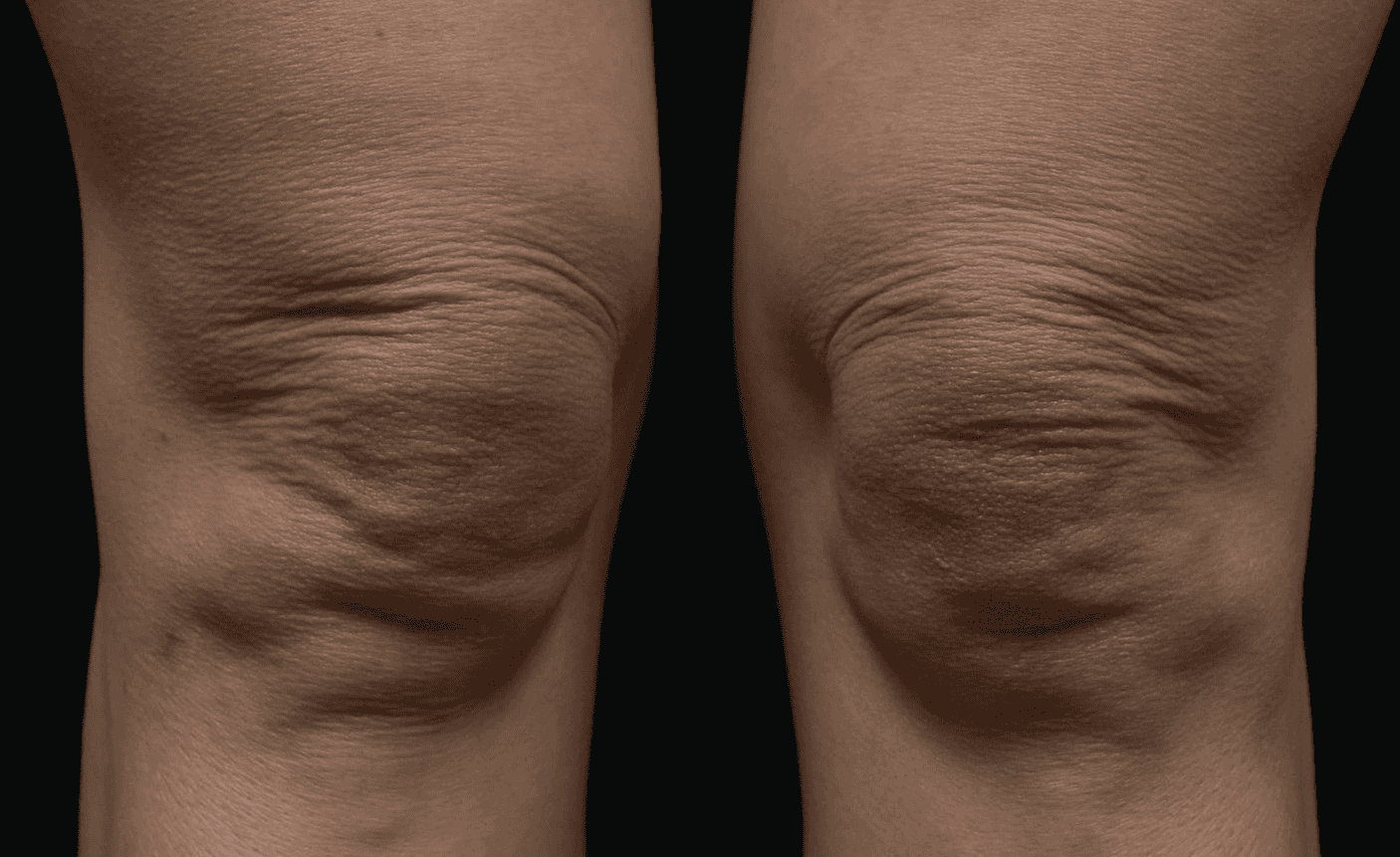 SOLTA_THERMAGE_HCP_BROCHURE_2025_05_12-35