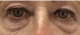 SOLTA_THERMAGE_HCP_BROCHURE_2025_05_12-41