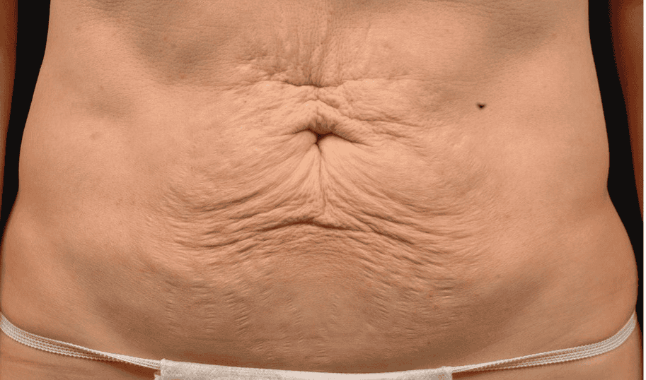 SOLTA_THERMAGE_HCP_BROCHURE_2025_05_12-45